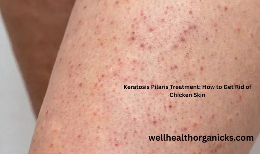 Keratosis Pilaris Treatment: How to Get Rid of Chicken Skin